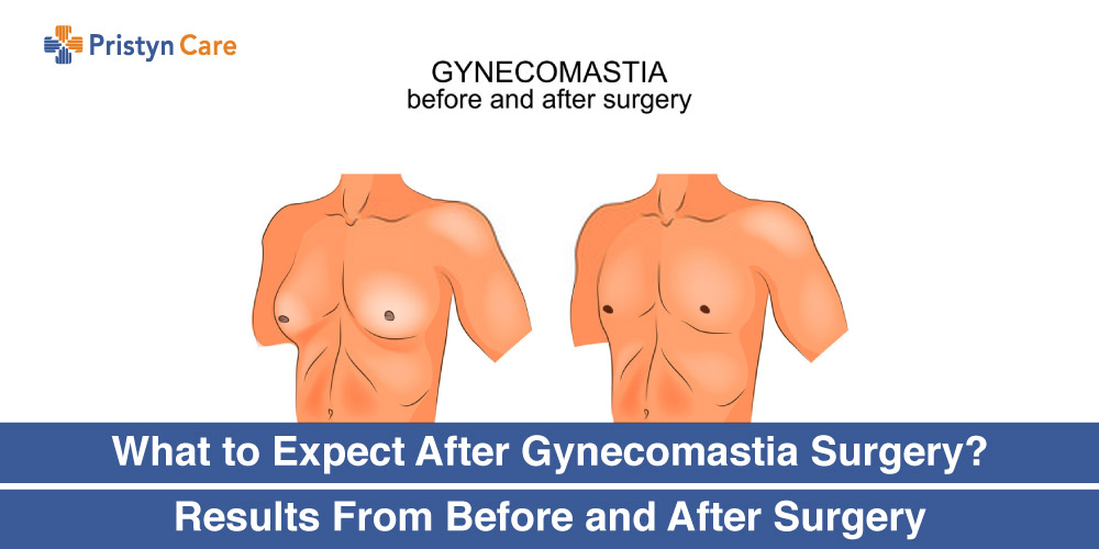 What-to-Expect-After-Gynecomastia-Surgery-Results-From-Before-and-After-Surgery