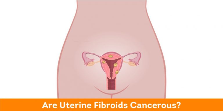 Are-Uterine-Fibroids-Cancerous