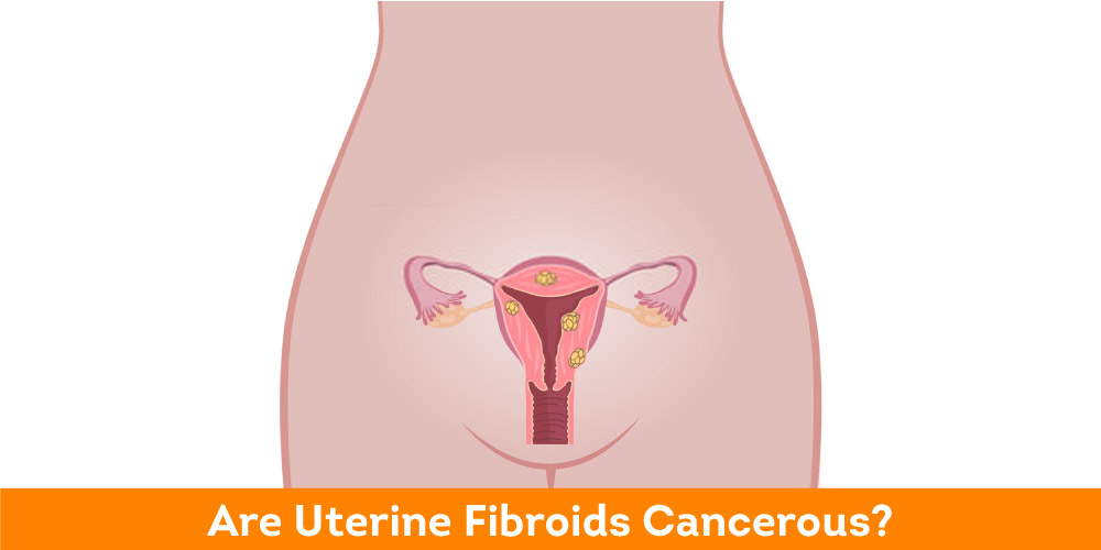 Are-Uterine-Fibroids-Cancerous