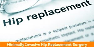 Minimally Invasive Hip Replacement Surgery