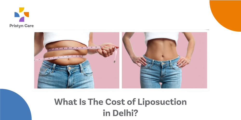 What-Is-The-Cost-of-Liposuction-in-Delhi