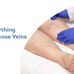 Know-Everything-About-Varicose-Veins-Surgery