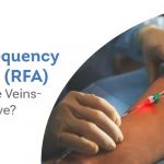 Radiofrequency Ablation for Varicose Veins