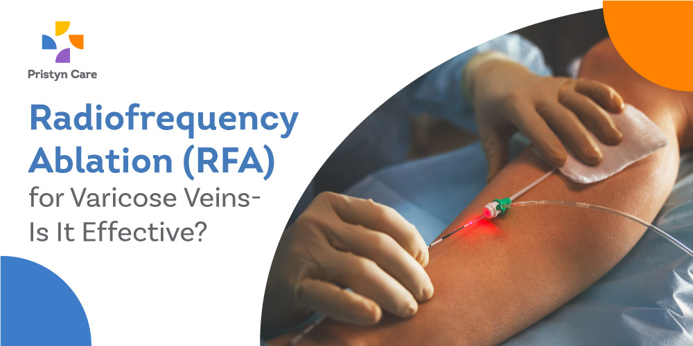 Radiofrequency Ablation for Varicose Veins