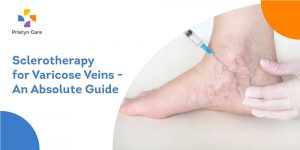 Sclerotherapy for varicose veins