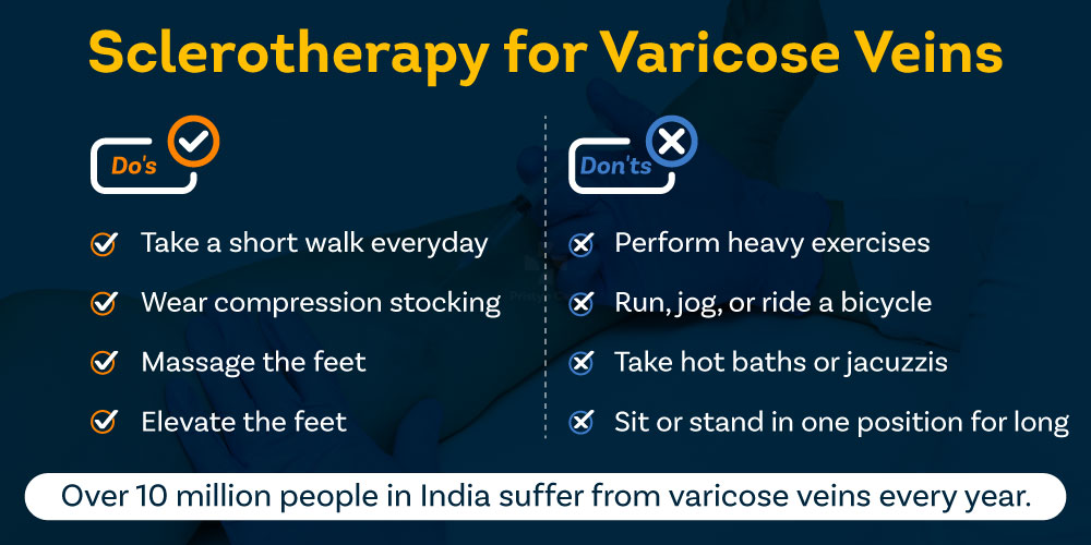 Sclerotherapy for Varicose Veins An Absolute Guide Pristyn Care