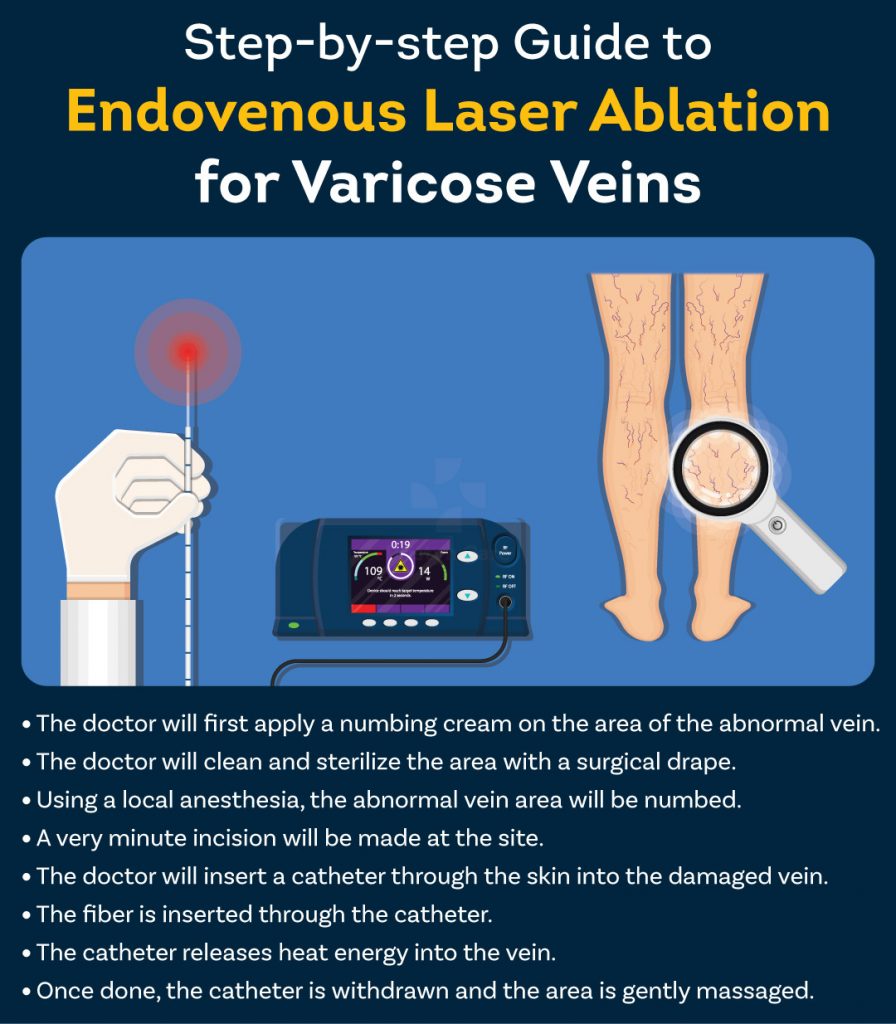 Endovenous Laser Ablation of Varicose Veins An Absolute Guide