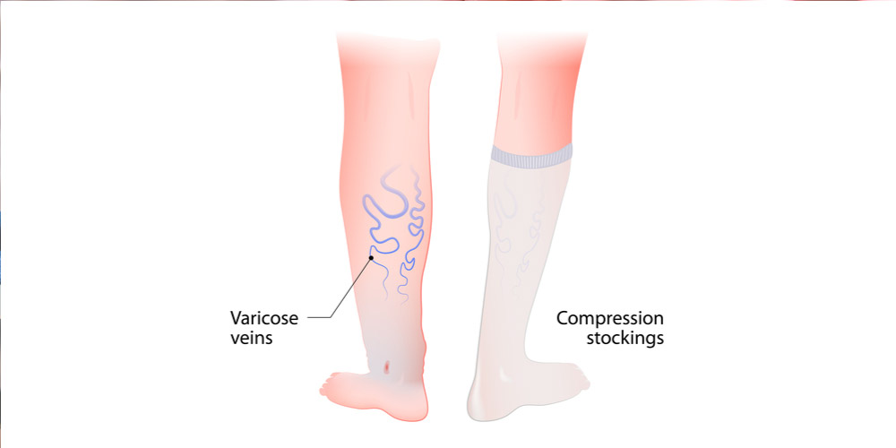 compression stockings for varicose veins in legs