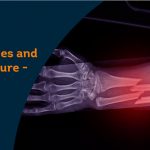 connection between kidney stones and bone fracture