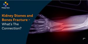 connection between kidney stones and bone fracture