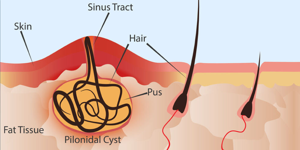 Pilonidal Sinus Laser Treatment Cost In India