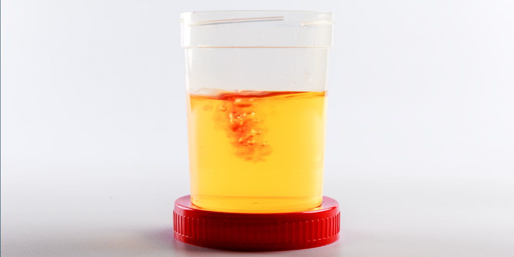 causes of blood in urine