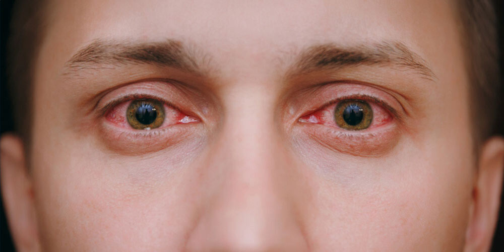 causes of eye discharge