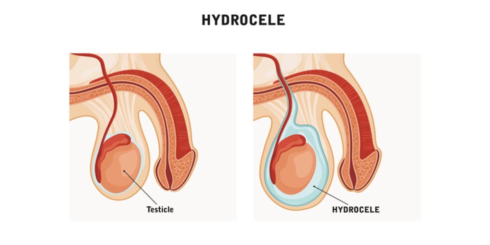 image showing normal testicles vs hydrocele 