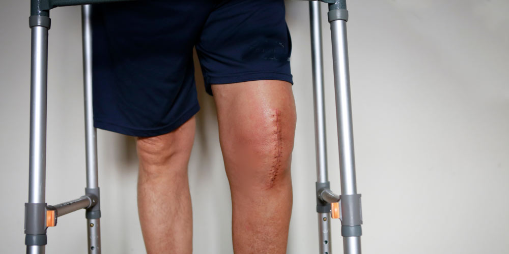 How to prepare for a Knee Replacement Surgery Pristyn Care