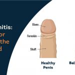 Balanoposthitis