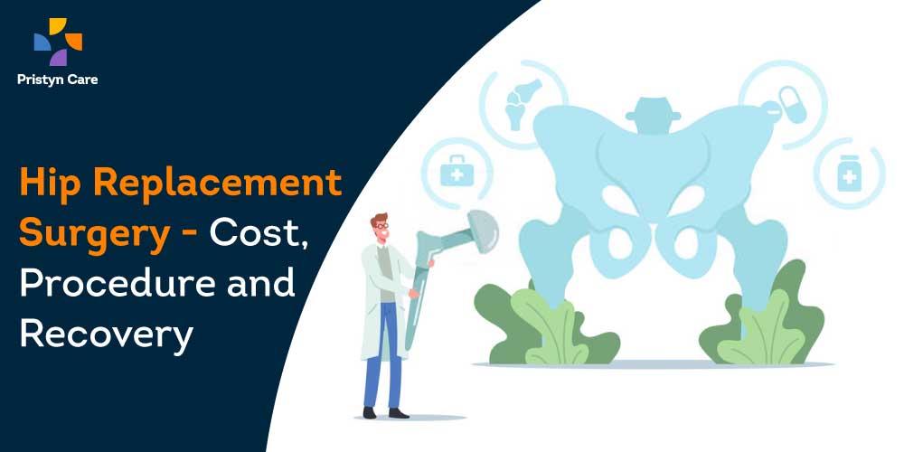 Hip replacement surgery cost, procedure and recovery
