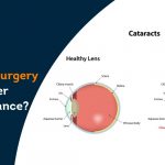 cataract-surgery-health-insurance