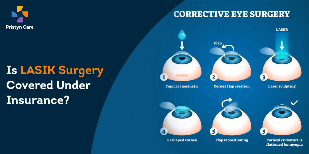 lasik-surgery-covered -under-insurance