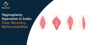 Vaginoplasty Operation in India