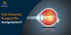 cataract-astigmatism