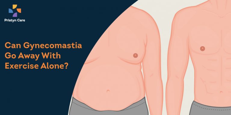  Can Gynecomastia Go Away With Exercise Alone?