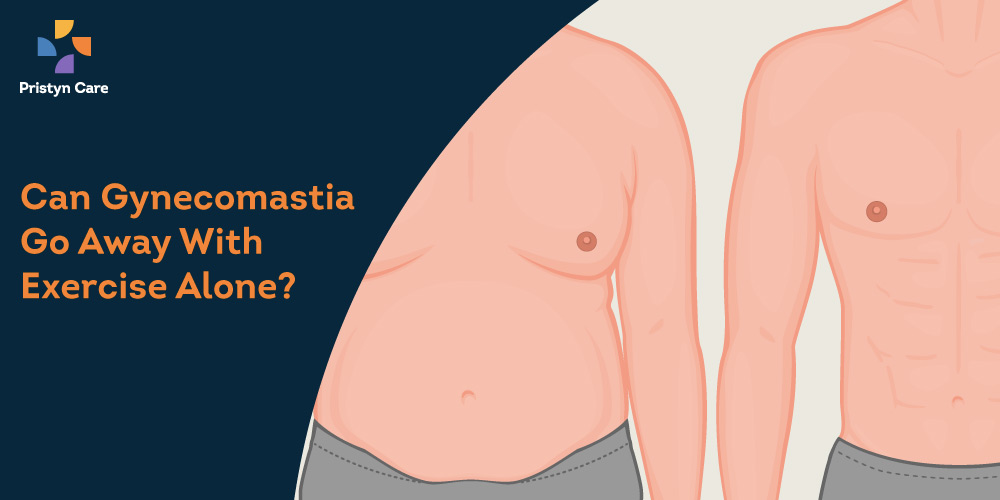 Can Gynecomastia Go Away With Exercise? 2