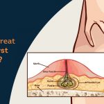 treat-pilonidal-cyst-using-laser