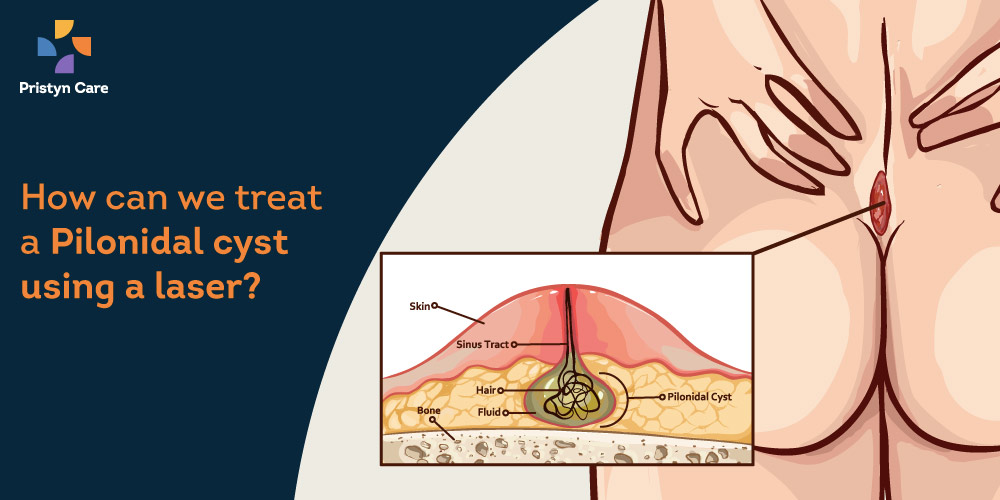 treat-pilonidal-cyst-using-laser