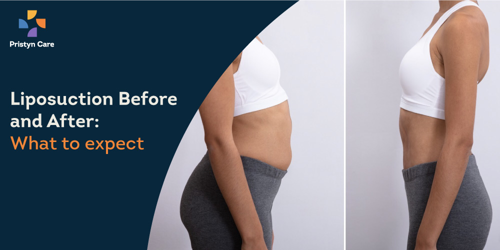 liposuction-before-and-after