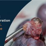 Ovarian Cyst Removal Operation in India