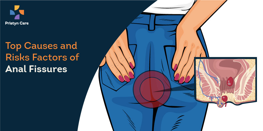 Can Anal Fissure Cause Severe Bleeding Telegraph