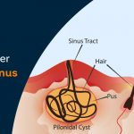 open-vs-laser-pilonidal-sinus-treatment