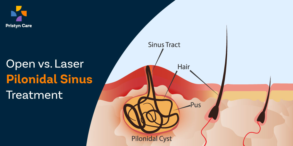 open-vs-laser-pilonidal-sinus-treatment