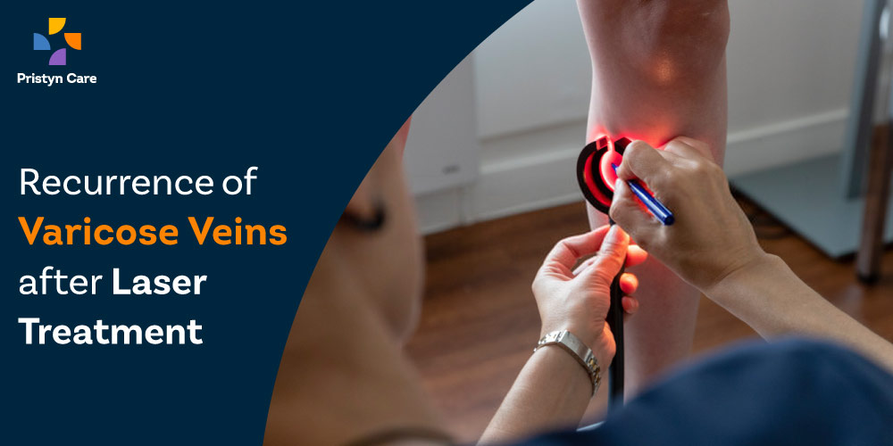 recurrence-of-varicose-veins-after-laser-treatment