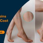 Varicose Veins Surgery Cost in Nagpur