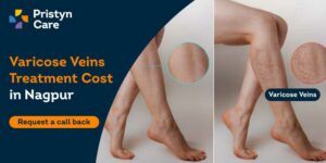 Varicose Veins Surgery Cost in Nagpur