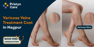 Varicose Veins Surgery Cost in Nagpur