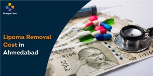 lipoma-cost-ahmedabad