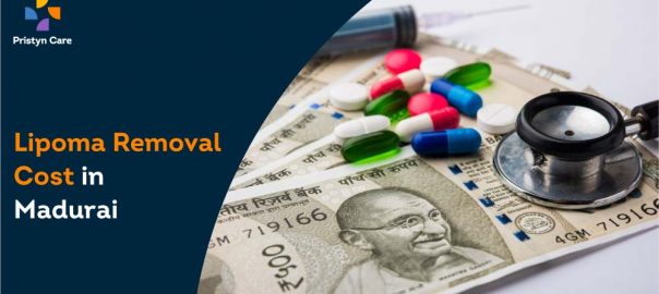 Lipoma Surgery Cost in Madurai