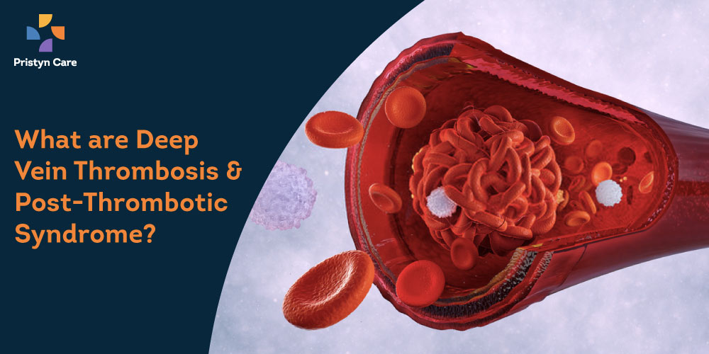 deep-vein-thrombosis -and-post-thrombotic-syndrome