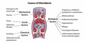 deep-vein-thrombosis-causes