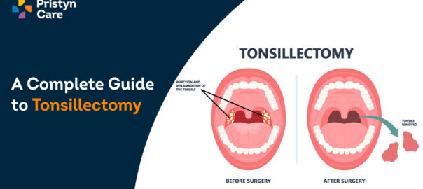 A Complete Guide to Tonsillectomy