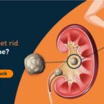 get rid of kidney stones
