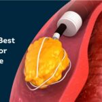 RIRS Surgery - Best Treatment for Kidney Stone Removal