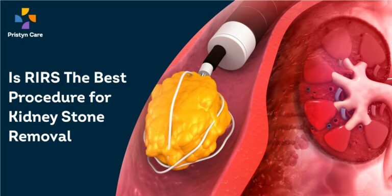 RIRS Surgery - Best Treatment for Kidney Stone Removal