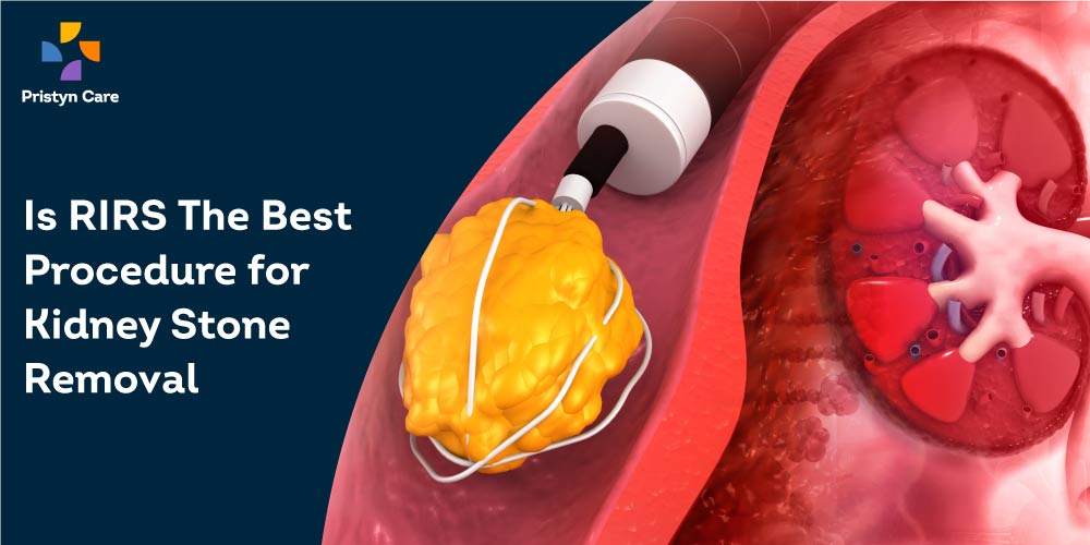 RIRS Surgery - Best Treatment for Kidney Stone Removal