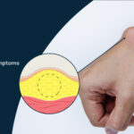 A Short Guide For Lipoma Treatment