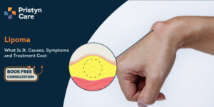 A Short Guide For Lipoma Treatment