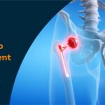 Cost of hip replacement
